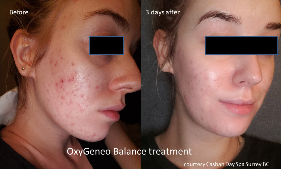before-and-after-oxygeneo-3.jpg