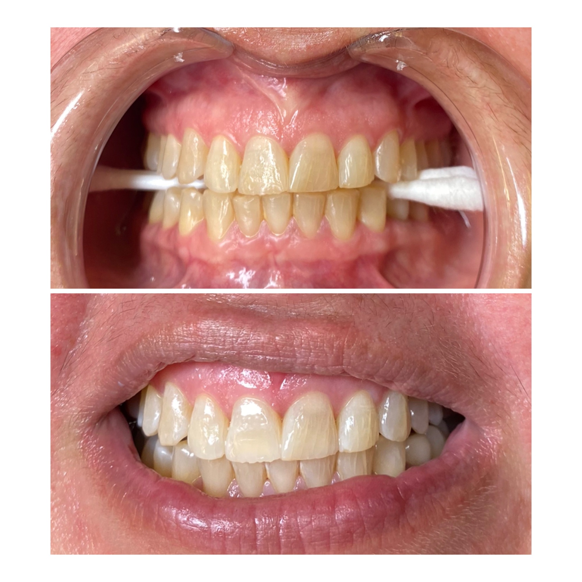 teeth-whitening-3-bA-1.jpg