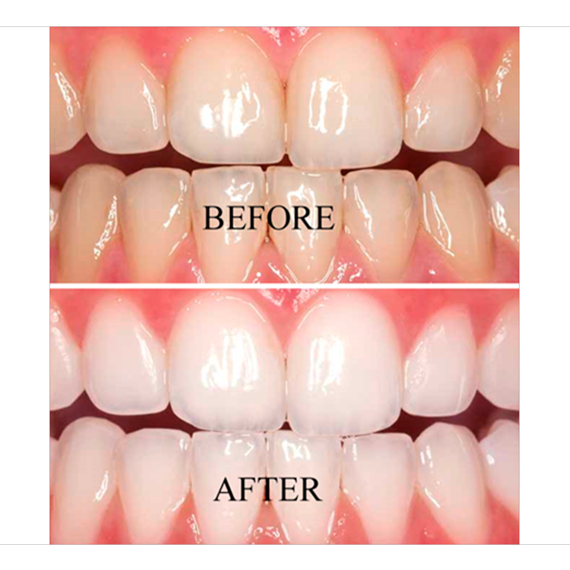 teeth-whitening-3-bAdental.png